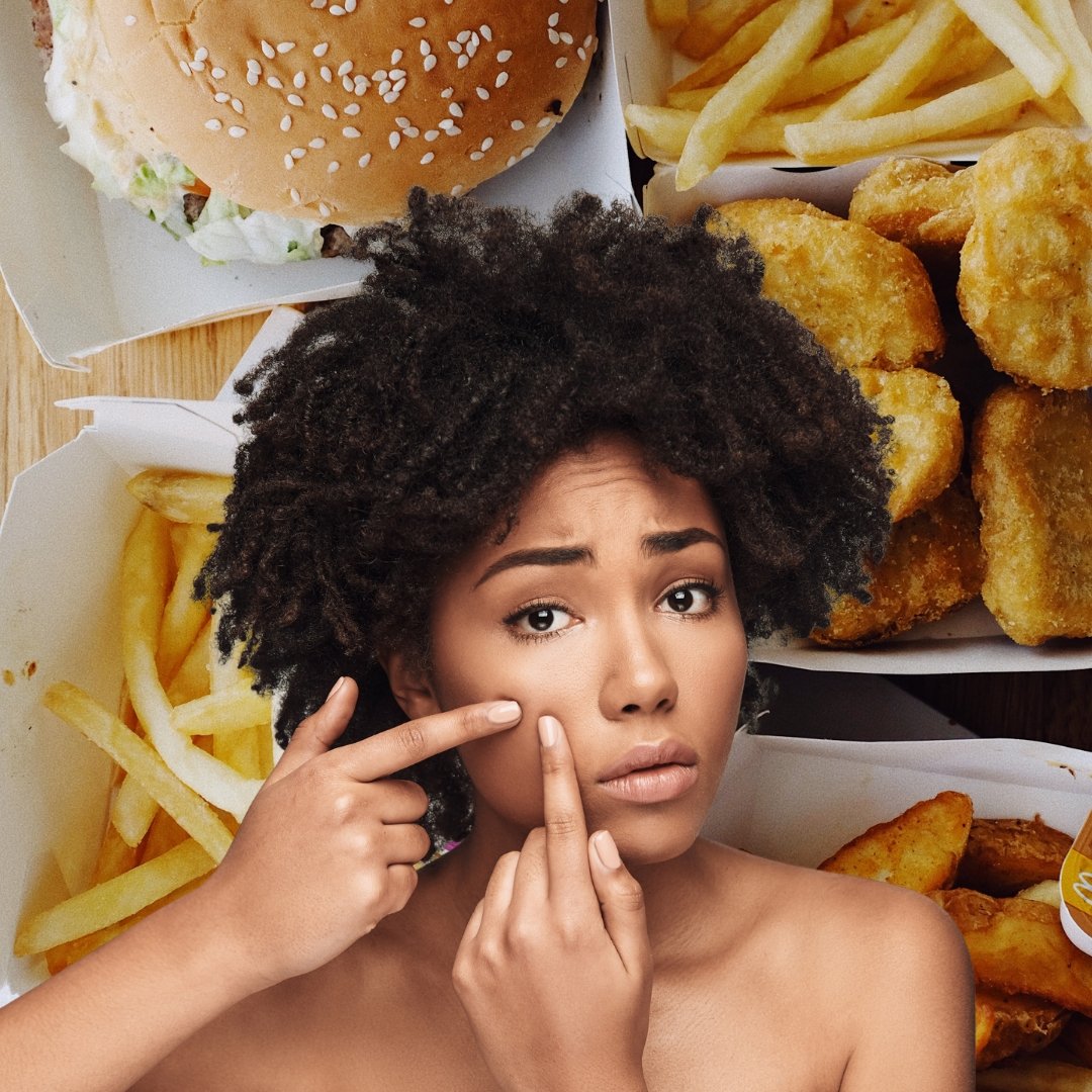 Acne-Prone Skin Diet: What to Eat and What to Avoid - Nirvana Natural Bliss Luxury Skincare                                                                                                                                                          